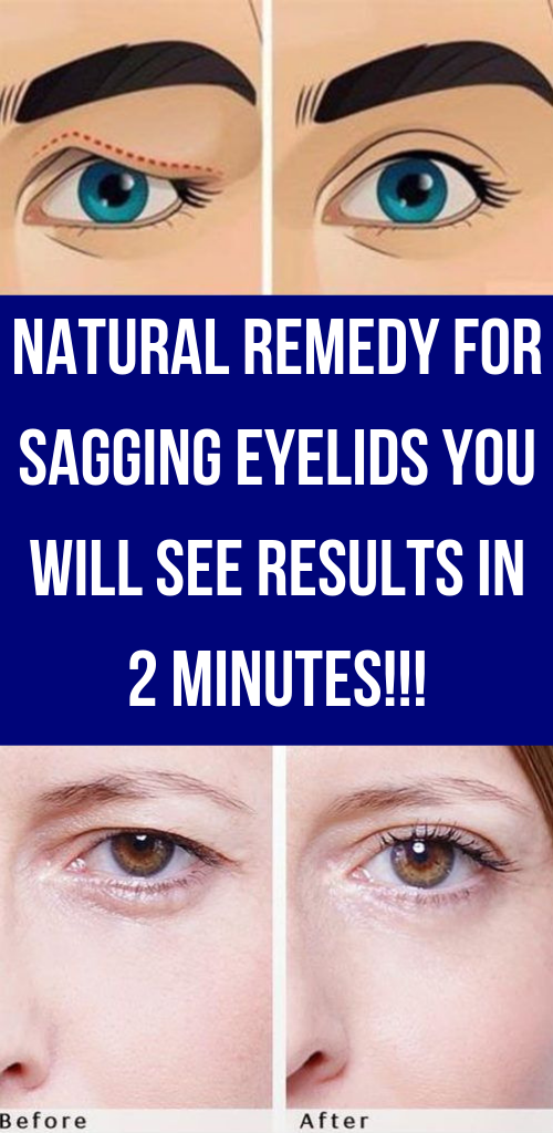 Natural Remedy For Sagging Eyelids You Will See Results In 2 Minutes!!!
