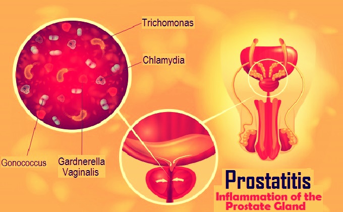 Növelje a leukocitákat a prosztatitisben