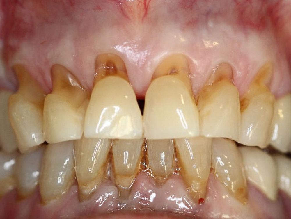 Abrasión Dental y el Cepillado Dental Directorio Odontológico