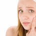 Acne Caused types Hormonal Factors