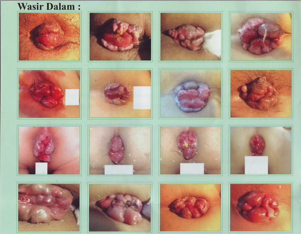 pengobatan hemoroid 