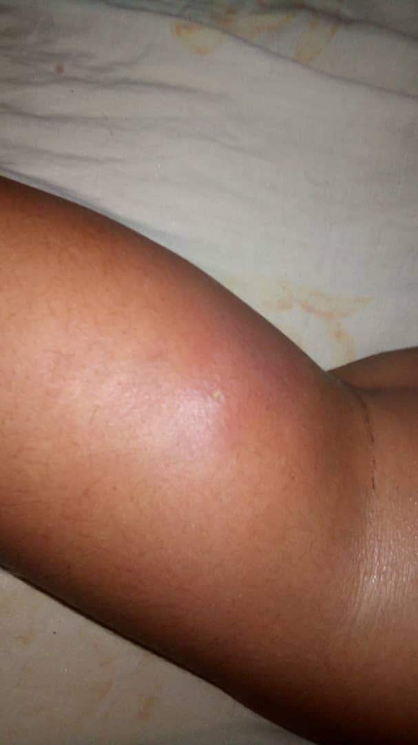 medicina natural para el celulitis