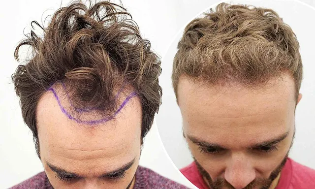 Hair transplant hair loss