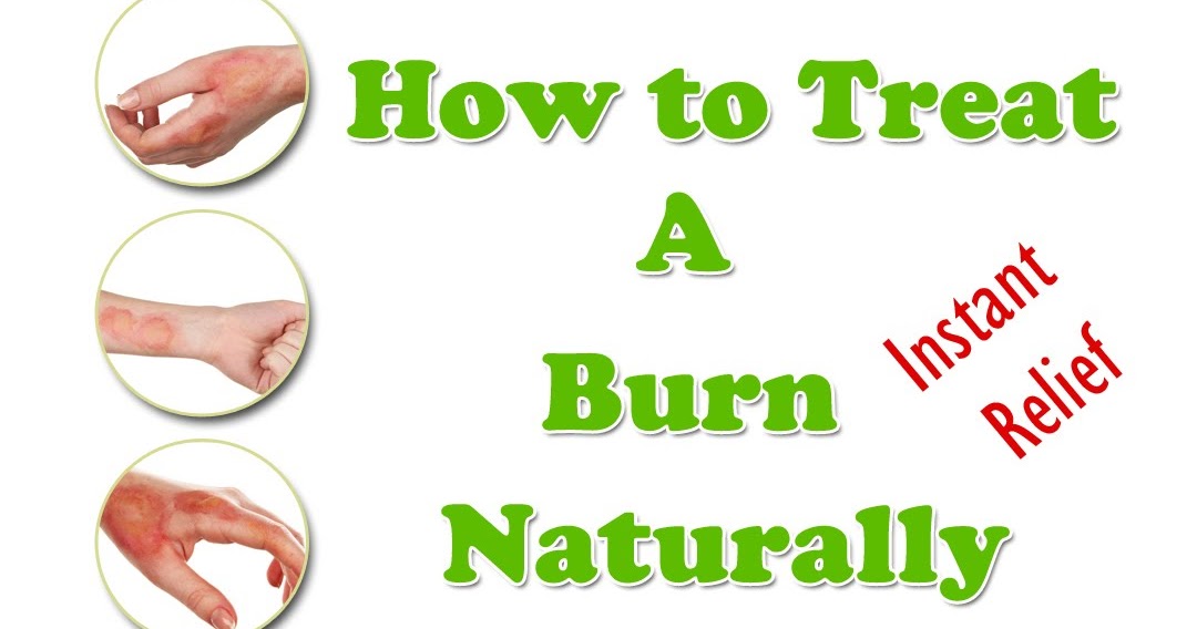 How to treat your burns TOP 5 DIY