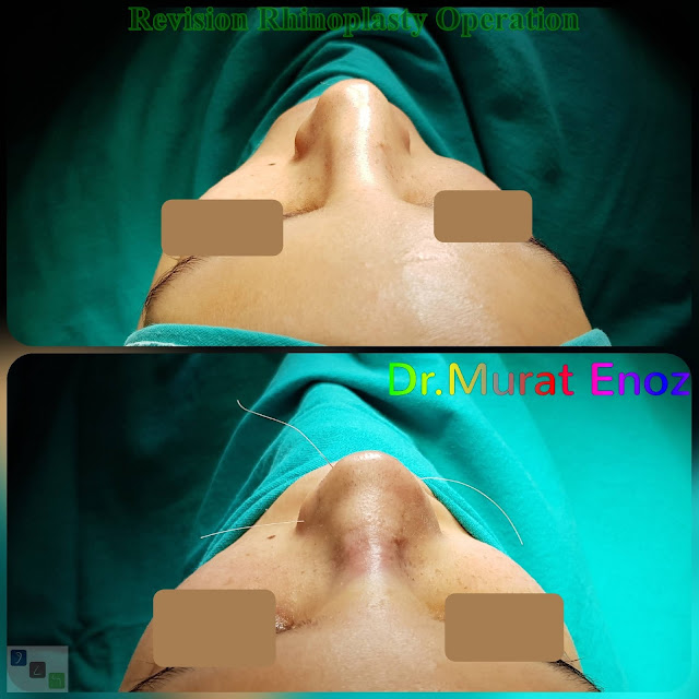Revision Rhinoplasty Operation in Istanbul, Ethnic Revision Nose Job Turkey