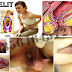 Obat Bab Berdarah (Wasir/Ambeien) di Apotik thumbnail