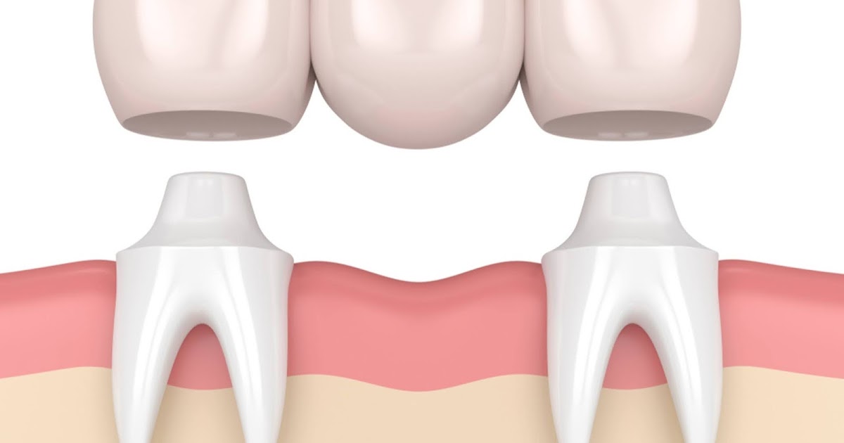 When to Replace a Dental Bridge?