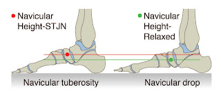 Navicular Drop Test Navicular Drop Test - El Paso Chiropractor