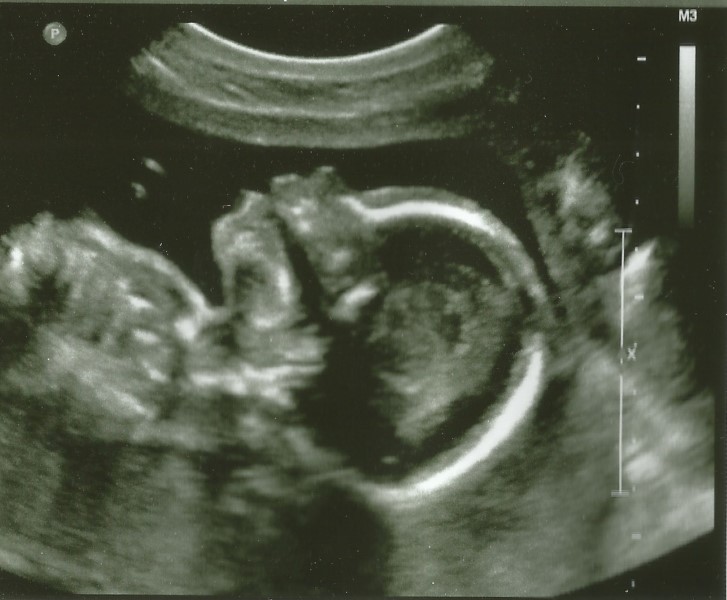 Unremarkable Files My Complete Placenta Previa Story