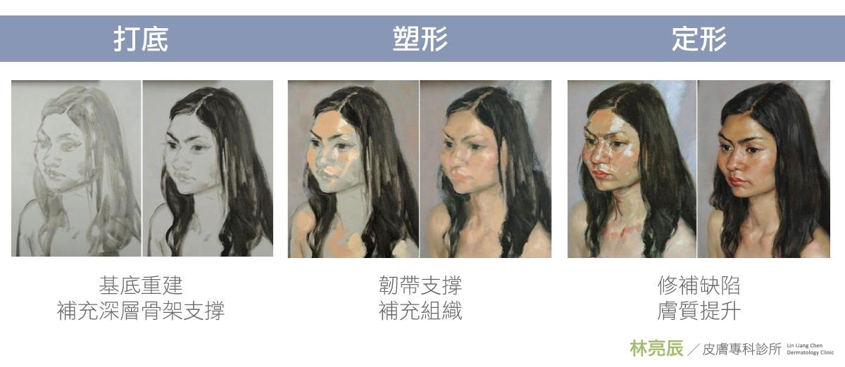 Sculptra-reunion