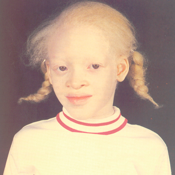 Альбинизмом страдают. Синдром Чедиака-Хигаси альбинизм. Фенилкетонурия и альбинизм.