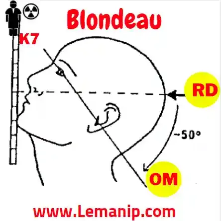 Incidence De Blondeau  Du Crane (WATER’S)