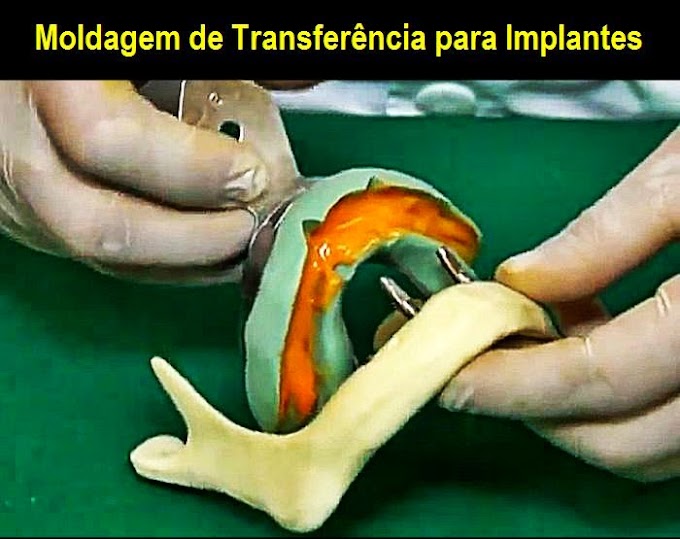 IMPLANTODONTIA: Moldagem de Transferência para Implantes