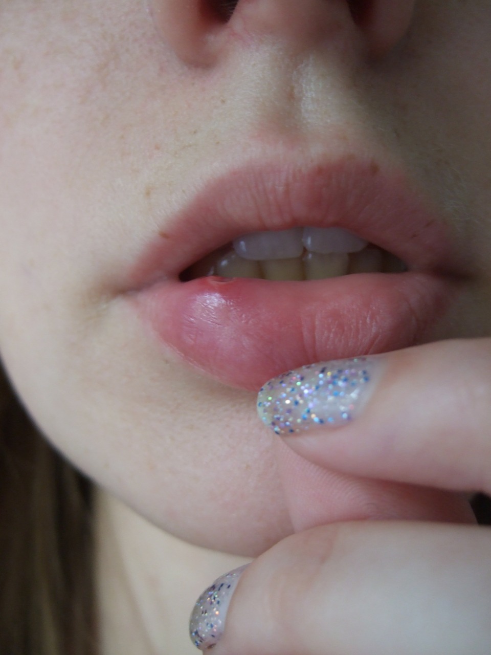Canker Sores On Lips How To Cure