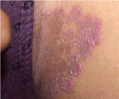 Jock Itch ( Tinea Cruris) – Pictures, Causes, Symptoms and ...
