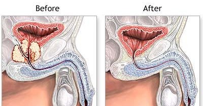 cum să învinge adenom de prostatita