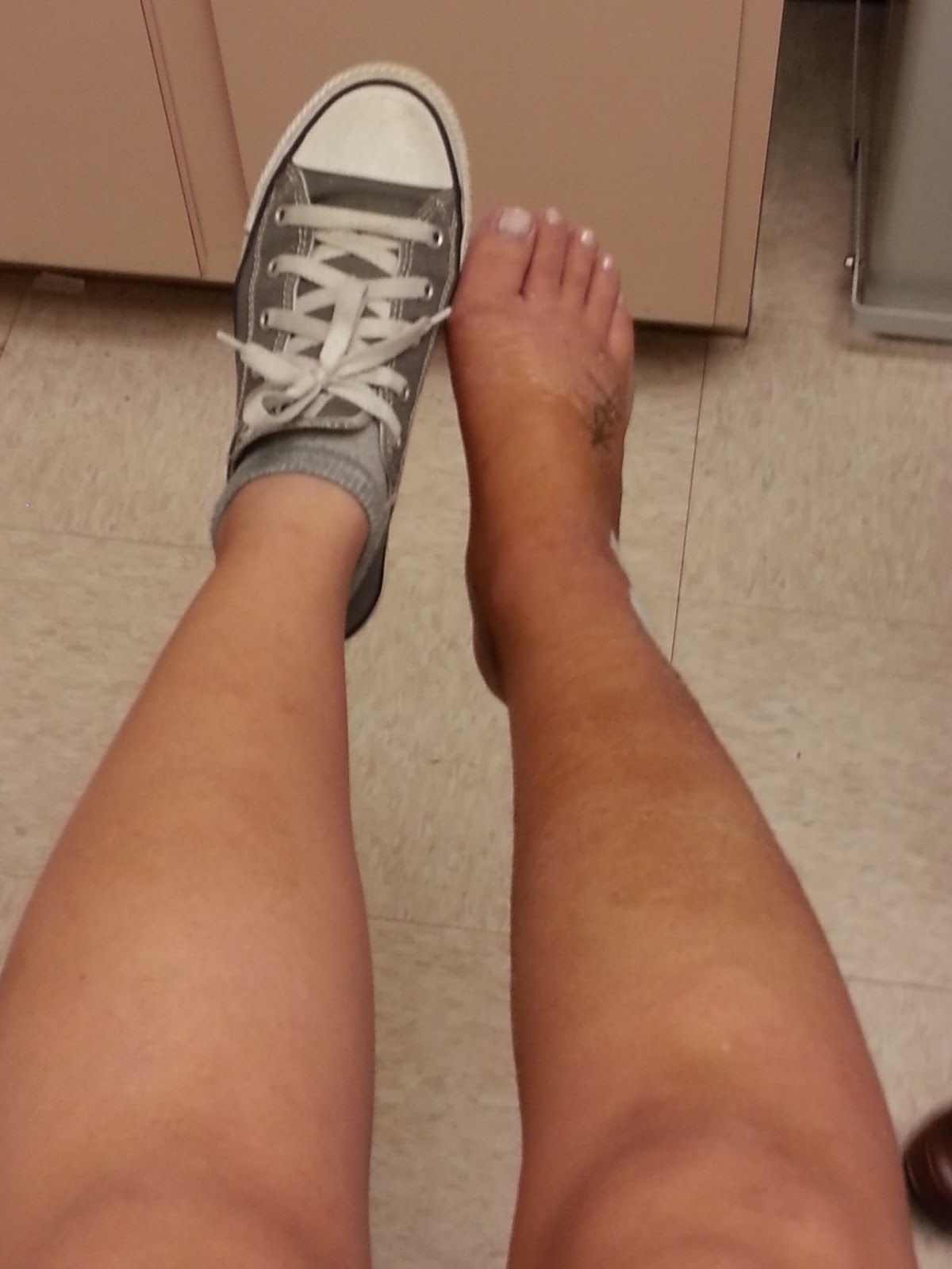 My Broken Ankle =( Cast Removal Day!
