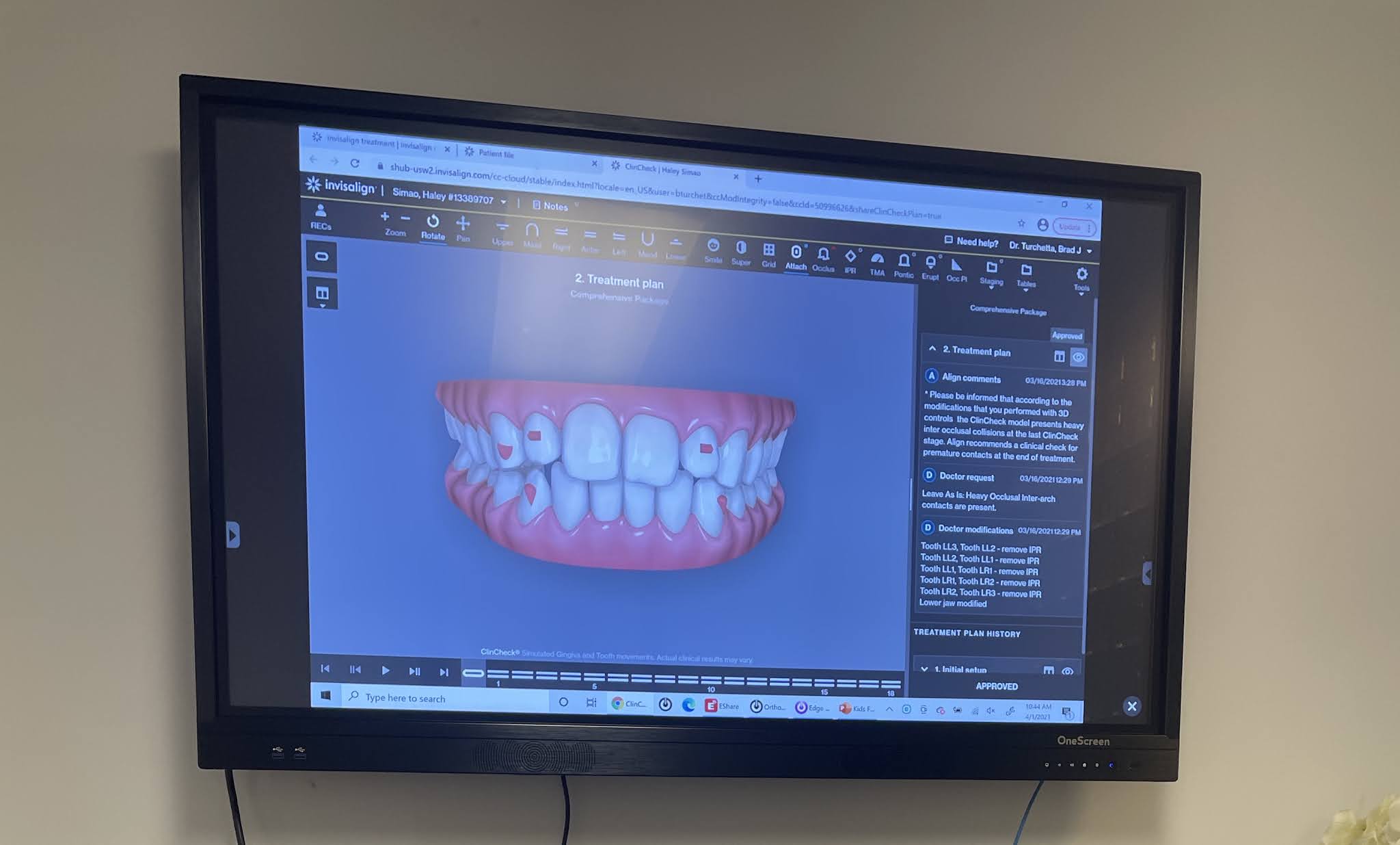 haleysimao Invisalign Treatment with RI Ortho Group Pre Treatment