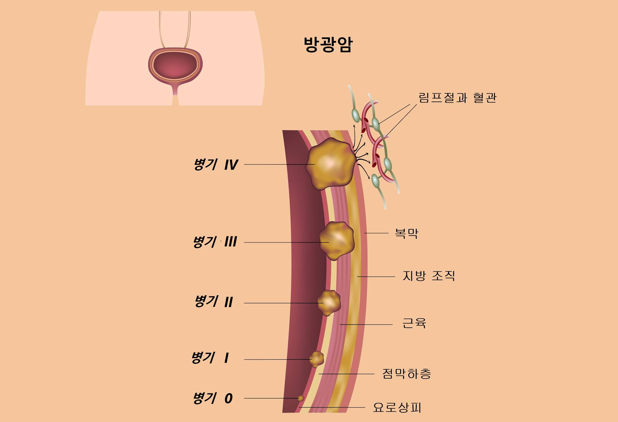 D07.3 난소의 비침윤성 장액성암, 저등급 일반암 진단비 보상 가능성은? D07.3 난소의 비침윤성 장액성암, 저등급 일반암 진단비 보상 가능성은?