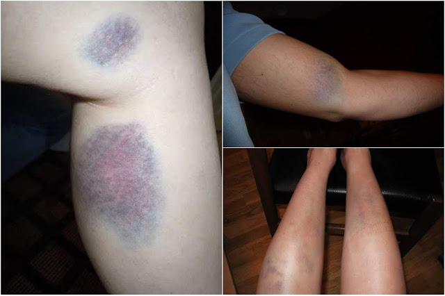 6 Tanda Leukimia Pada Tubuh yang Harus Anda Waspadai!