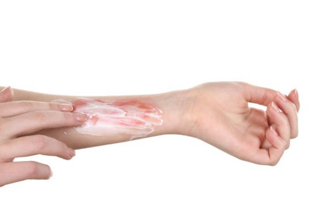Bagaimana cara menyembuhkan kulit merah muda yang terpapar akibat luka bakar bawang putih?