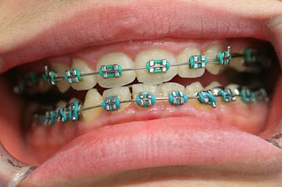 Các phương pháp niềng răng không nhổ răng