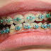 Các phương pháp niềng răng không nhổ răng