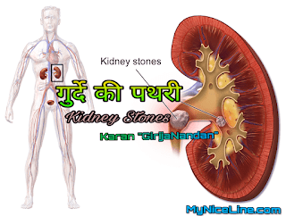 किडनी स्टोन के लक्षण, कारण, चिकित्सा, बचाव के विषय मे संपूर्ण जानकारी all information about the symptoms, causes, treatment, prevention of kidney stone in hindi