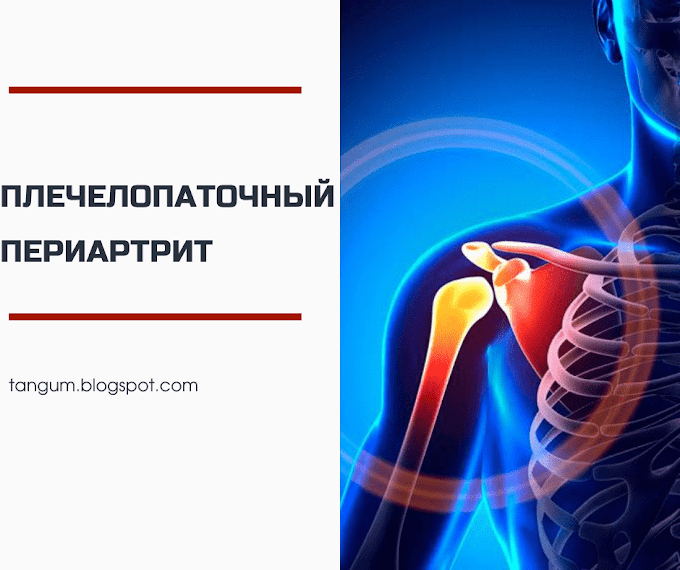 адгезивный капсулит капсулы плечевого сустава. плечелопаточный полиартрит. периартроз плечевого сустава. периартрит плечевого сустава. плечелопаточный периартрит плечевого сустава.