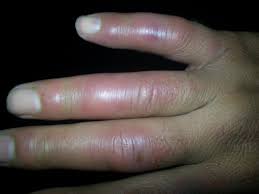 علاج تورم الاصابع فى الشتاء وكيفية الوقاية 