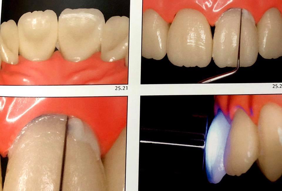 Adhesive cementation " emax cementation protocol “ Dental Esthetics