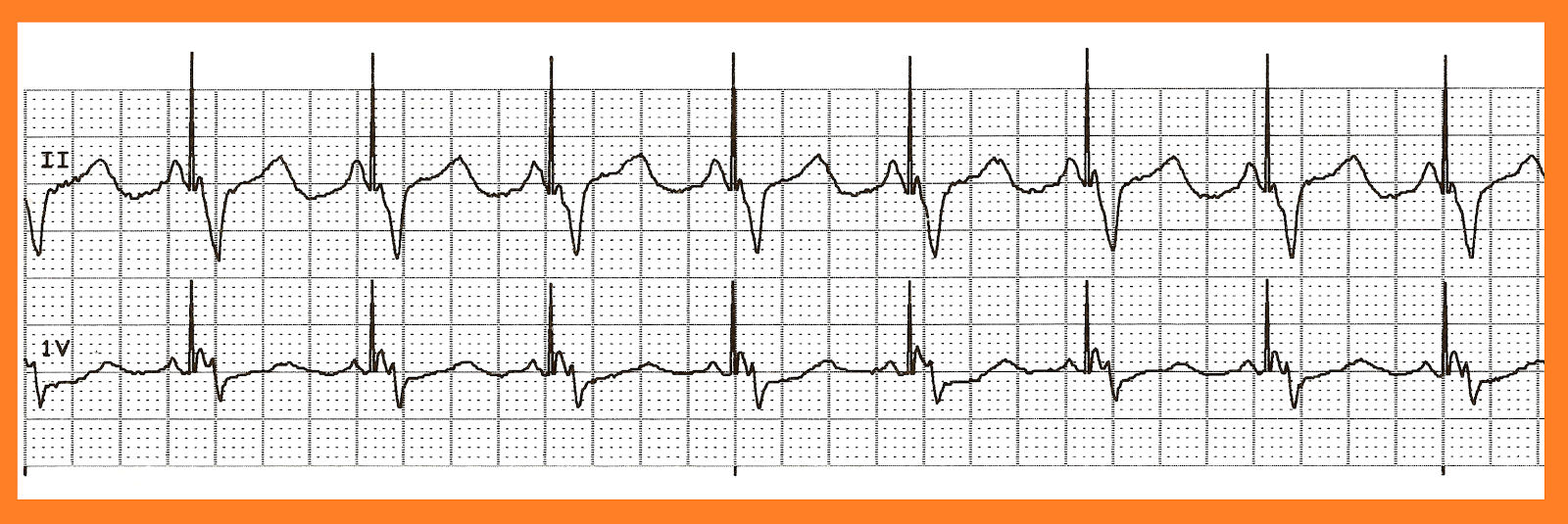 Atrial Sensed Ventricular Paced Rhythm – LPPYNU