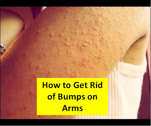 How to Get Rid of Bumps on your Arms Organically YouTube.