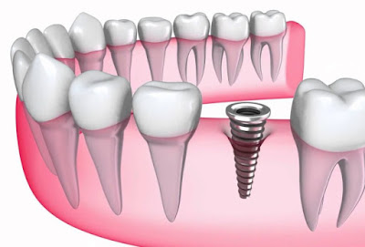 Địa chỉ trồng răng implant ở đâu tốt tại tphcm 2