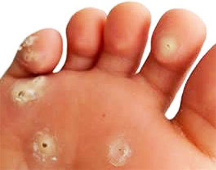 Foot Corn : Symptoms and Causes ! What is foot corn