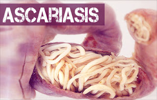Ascariasis Infestasi Cacing Parasit Ascaris Lumbricoides
