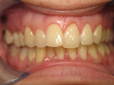Bọc răng sứ không kim loại cho răng ngả màu