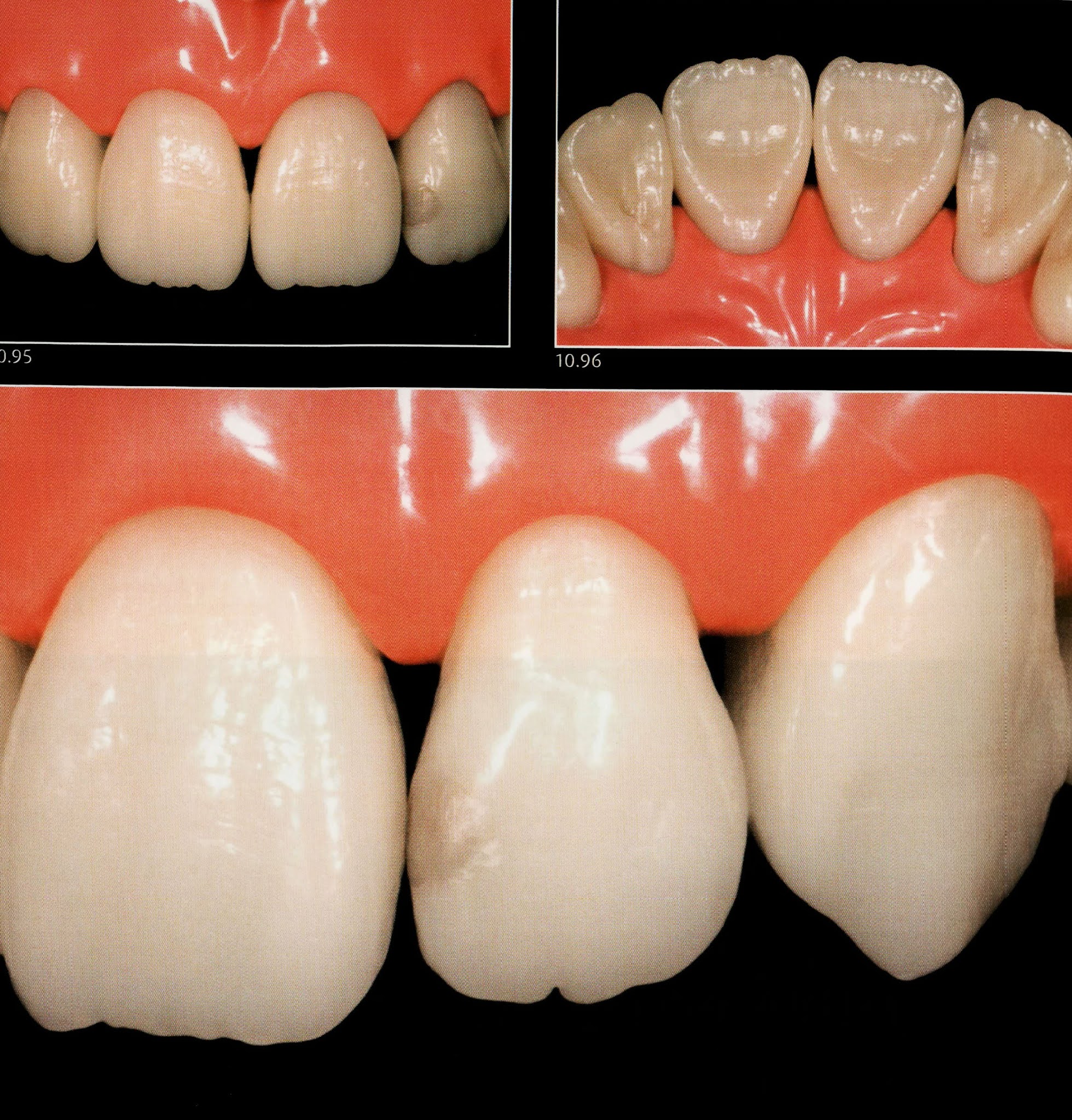 Class III Composite restoration " Labial access " Dental Esthetics