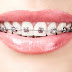 Tổng hợp ưu điểm các loại niềng răng