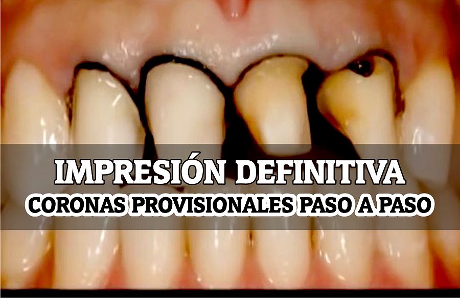 IMPRESIÓN DEFINITIVA y colocación de CORONAS PROVISIONALES Paso a Paso