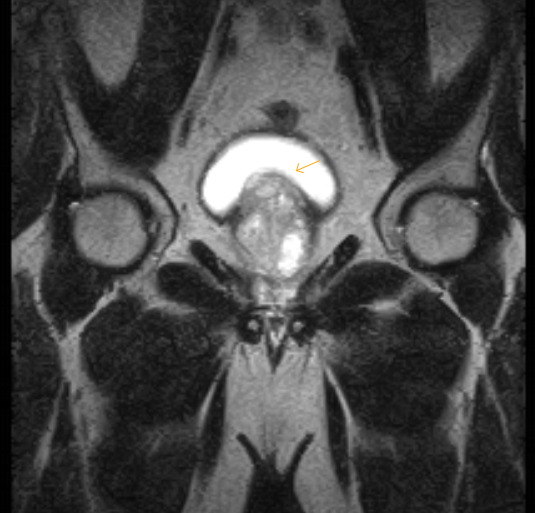 benign prostatic hyperplasia mri radiographics