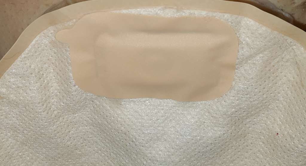 Hyper Stoma Guide To Using Ostomy Filter Stickers