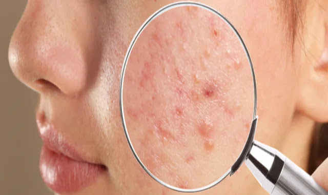 Treating acne in one day: is it possible?