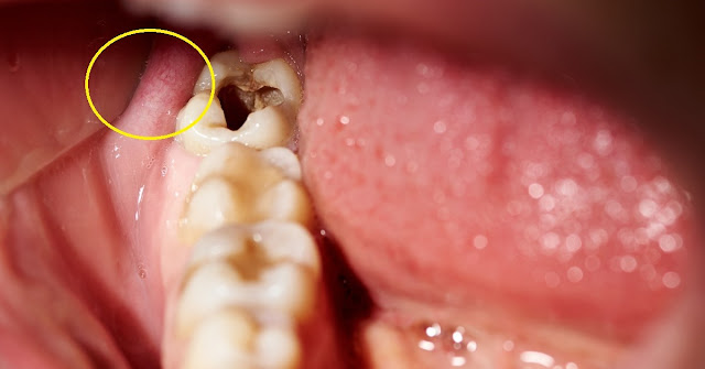 Abcès dentaire: quand une douleur dentaire peut se terminer par une pneumonie