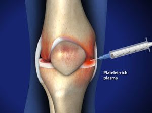 http://kneecareindia.in/platelet-rich-plasma