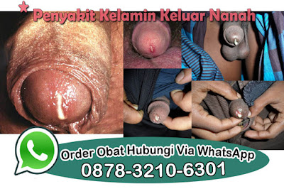 Ramuan Alami Obat Kencing Nanah 