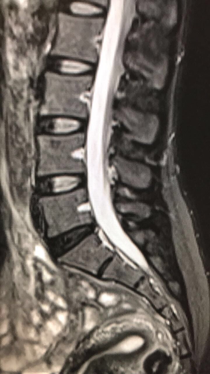 Running Solutions How Is Running Good For Your Back?