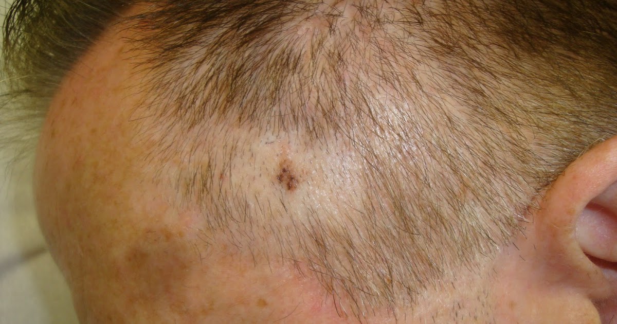 consultations-in-dermatology-melanoma-scalp