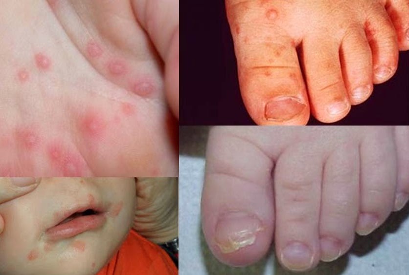 LA ENFERMEDAD BOCAMANOPIE