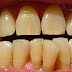  Răng bị nhiễm kháng sinh có tẩy trắng được không